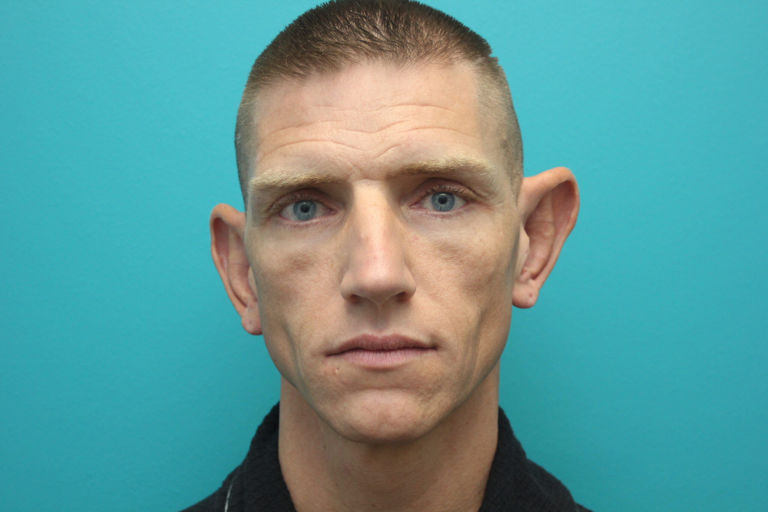 Gallery of Facial procedures Modern Surgical Arts of Denver