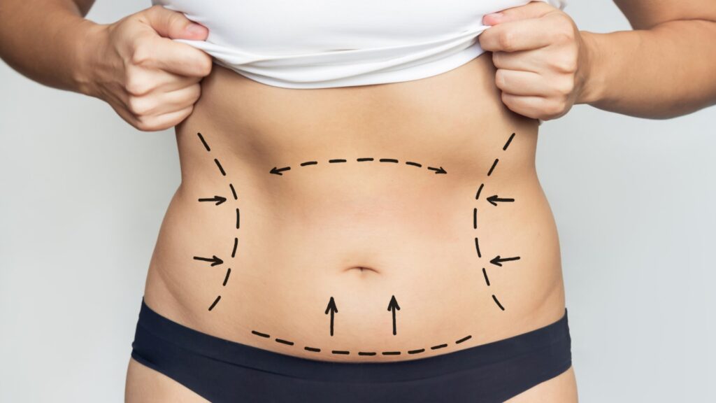 How Long Does It Take to Recover from Liposuction? | Modern Surgical Arts of Denver