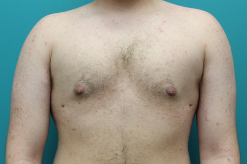 Gynecomastia Frontal After