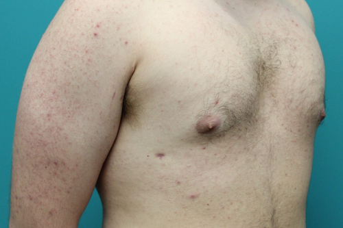 Gynecomastia Lateral After