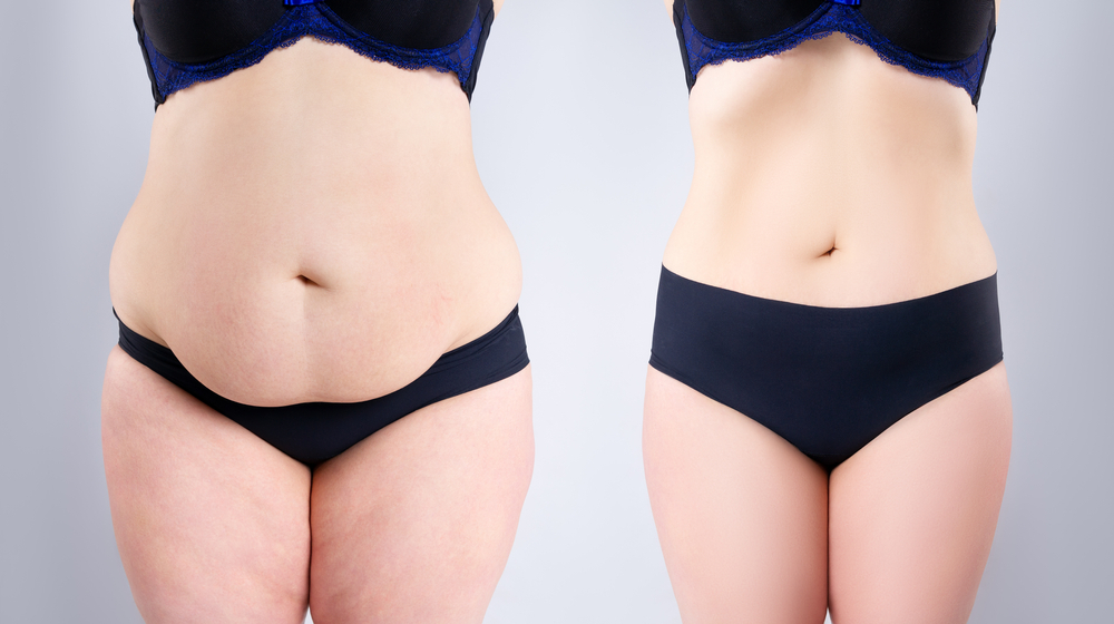 Post-Liposuction Recovery: A Detailed Timeline and Expectations | Modern Surgical Arts of Denver