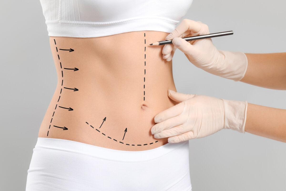 What Does the Circumferntial Tummy Tuck Recovery Timeline Look Like?