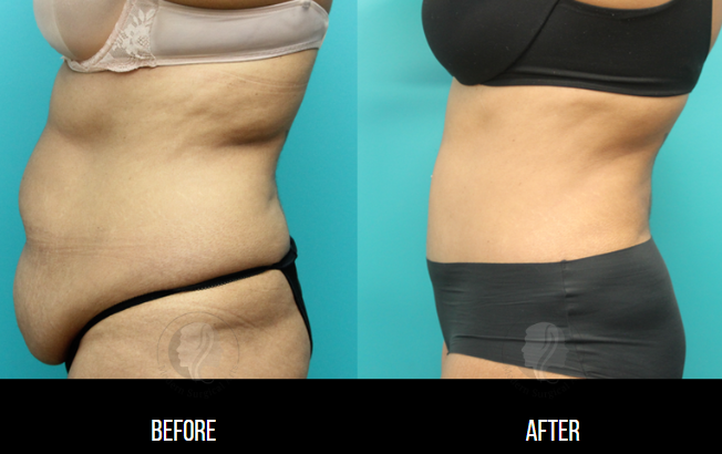 Am I A Good Candidate For A Tummy Tuck? — HZ Plastic Surgery
